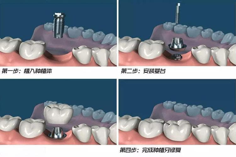 种颗大牙大概多少钱