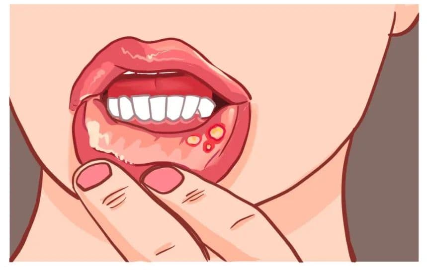 经常口腔溃疡真的会癌变吗？癌前征兆有哪些？该如何预防呢？