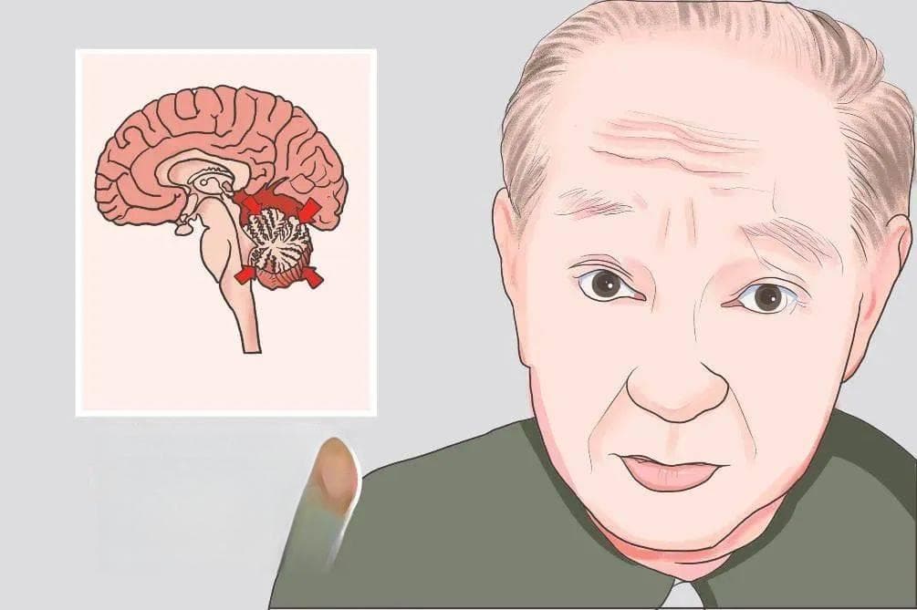 脑梗死有哪些临床表现？如何护理脑梗死患者？