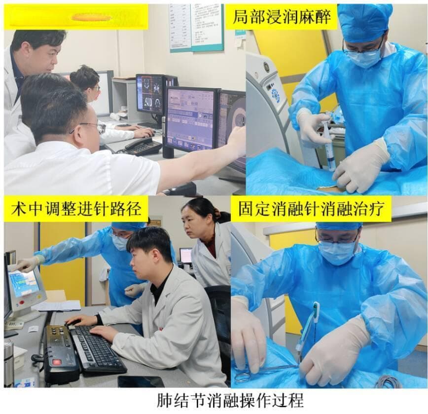 高龄肺结节手术难，微波消融助患者解“危局”