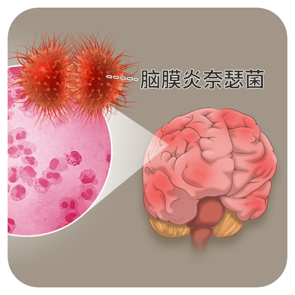 脑疽现代叫什么病