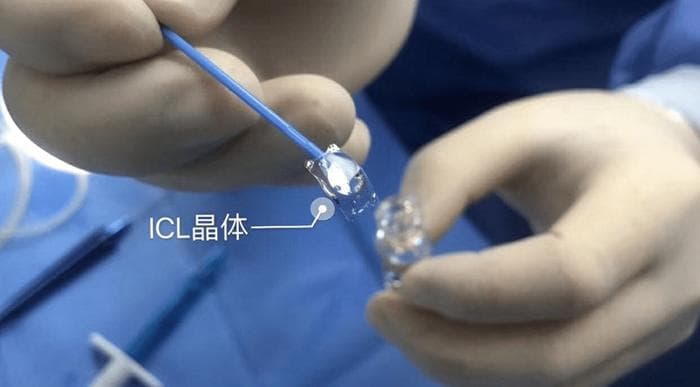 如何选择靠谱的icl晶体植入术医生(成都篇)