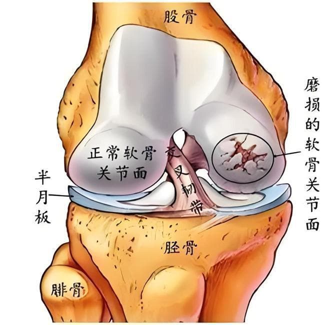 运动后膝盖疼可以吃氨糖吗？氨糖真的对膝关节有用吗？