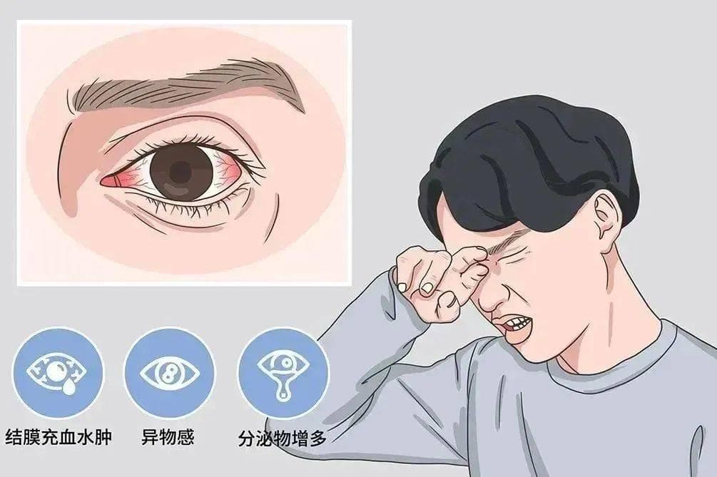 3种类型的结膜炎，治疗方法上有什么不同？