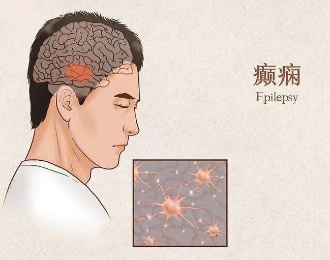 “羊癫疯”是什么？发作怎么办？丨健康总动员