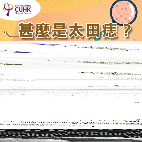 什么是太田痣？