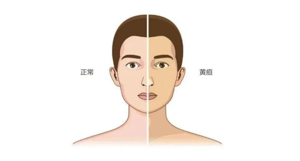 肝不好的人留意 “一黄二红三黑”，这些可能是肝脏发出的警报！