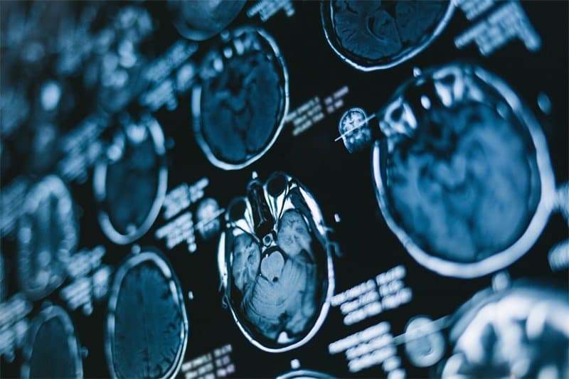 左下脑CPA占位表皮样囊肿：成因、症状与治疗全解析