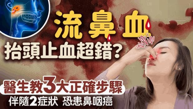 医生教3大止鼻血步骤，伴随2症状恐是鼻咽癌