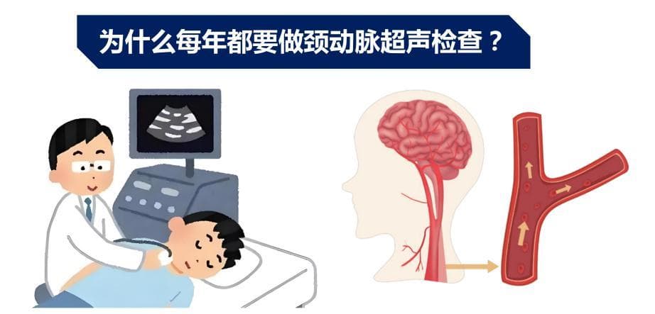 颈动脉超声检查：必要性、适用人群及积极意义全解析