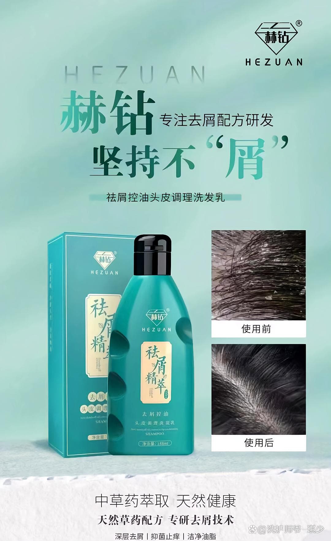 头皮癣脂溢性皮炎头皮屑多怎么去除最简单方法