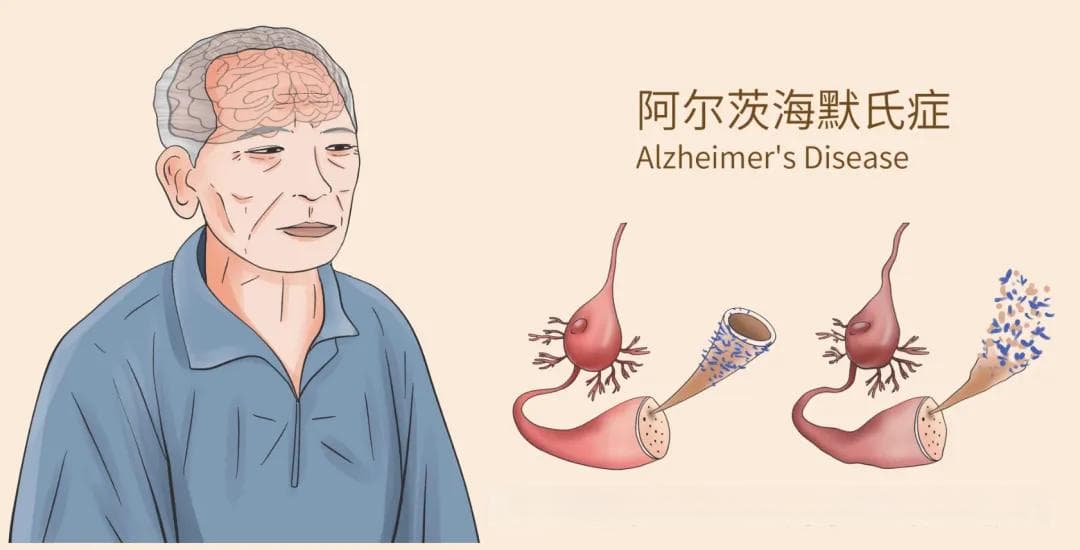 老年脑健康：阿尔茨海默病的十大征兆与十二种预防方法
