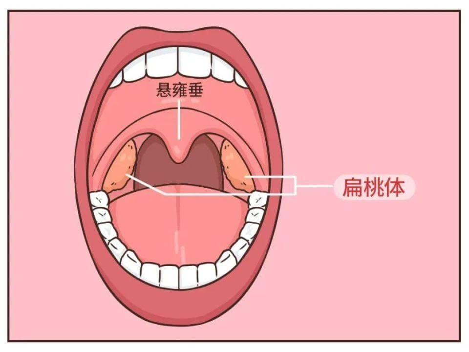 扁桃体切除手术虽小，也有潜在风险，耳鼻喉科医生给家长们提几个醒