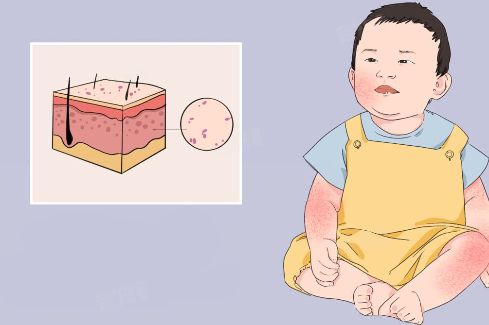 儿童疱疹怎么治疗最快方法