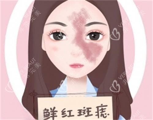 染料激光的作用和功效：去红血丝/去疤痕/玫瑰痤疮等