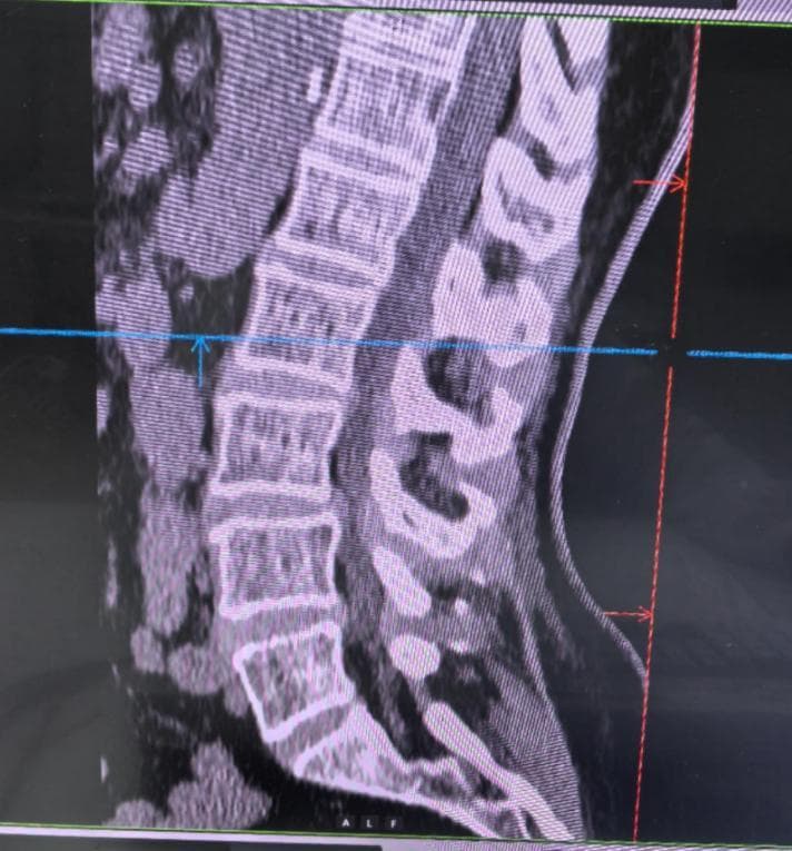 CT 检查：洞察腰部健康的利器