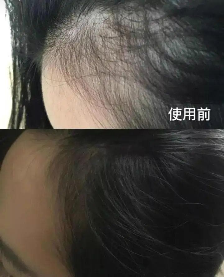 用脱发“救星”米诺地尔竟然要掉这么多头发？