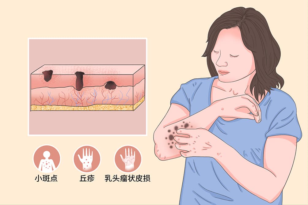 皮内痣：症状、诊断与治疗全解析