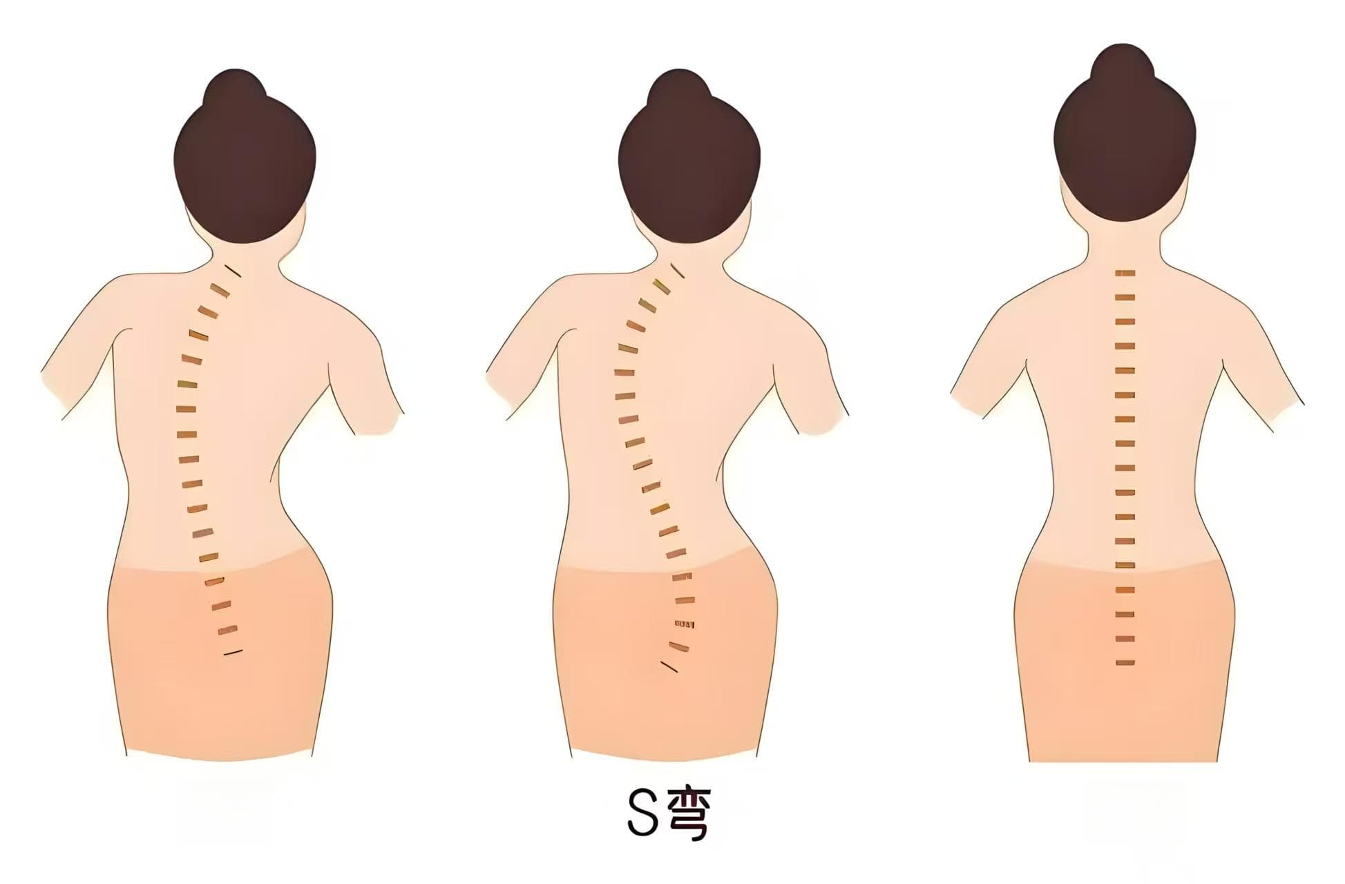 脊柱侧弯会遗传吗？
