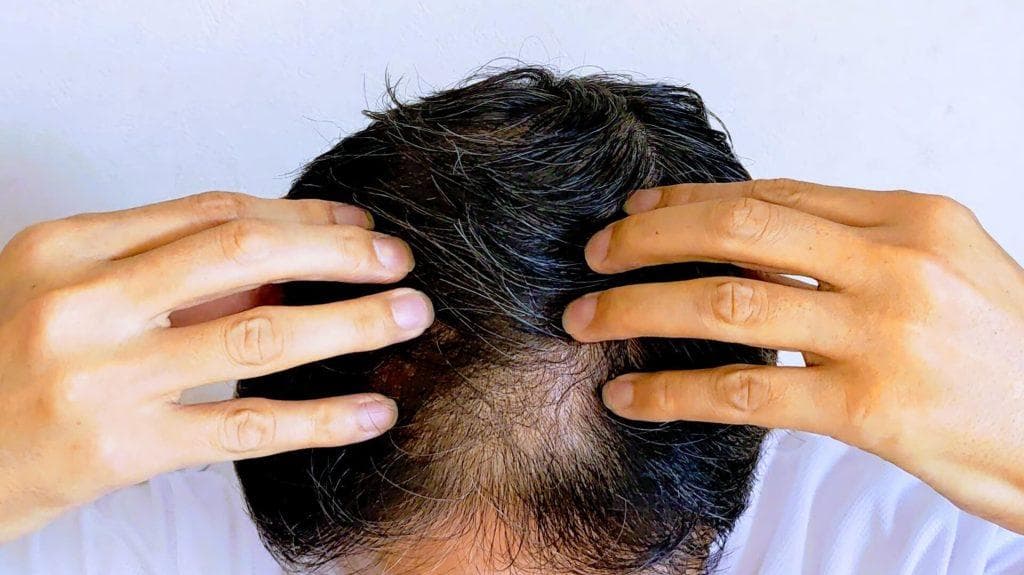 雄性脱发怎么办？成因、症状、治疗全方位解析