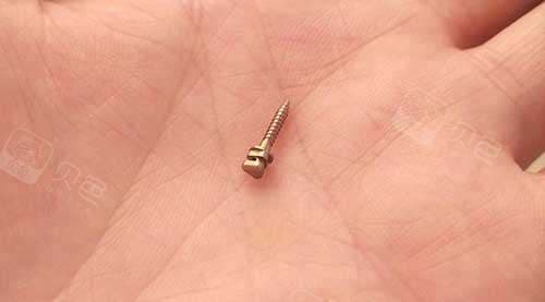必知!正畸打骨钉和不打骨钉的区别,除了加快正畸时间,打骨钉还有这些优势