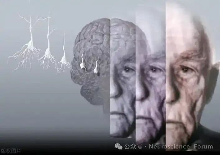盘点那些可逆性痴呆：痴呆症≠阿尔茨海默病