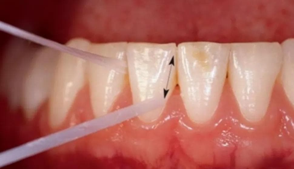 牙线、牙间隙刷（牙缝刷）和冲牙器如何选择？