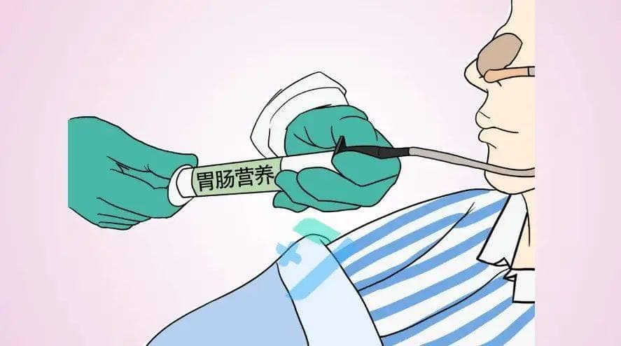如何护理鼻饲患者？掌握这些要点轻松应对！