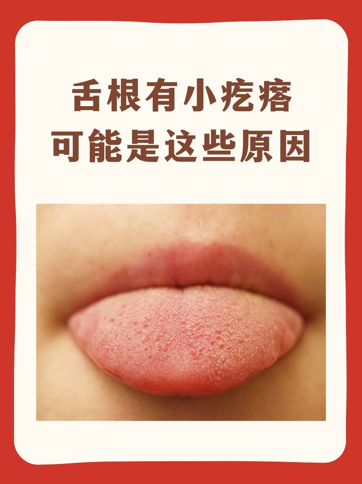 舌根有小疙瘩，可能是这些原因