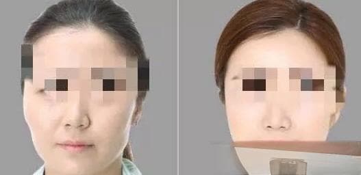 颧骨内推和磨骨哪个风险大