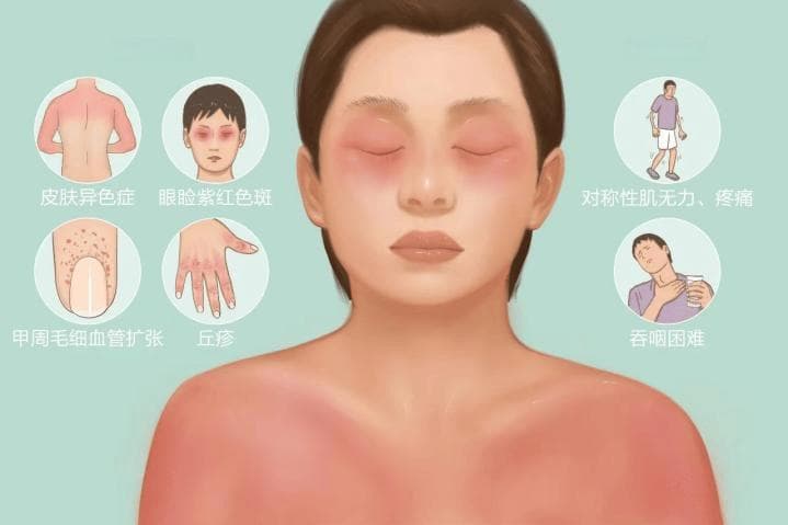 发热、皮疹、关节痛？一文揭开“皮肌炎”的神秘面纱