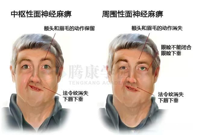 【康复科普】中枢性面瘫 VS 周围性面瘫