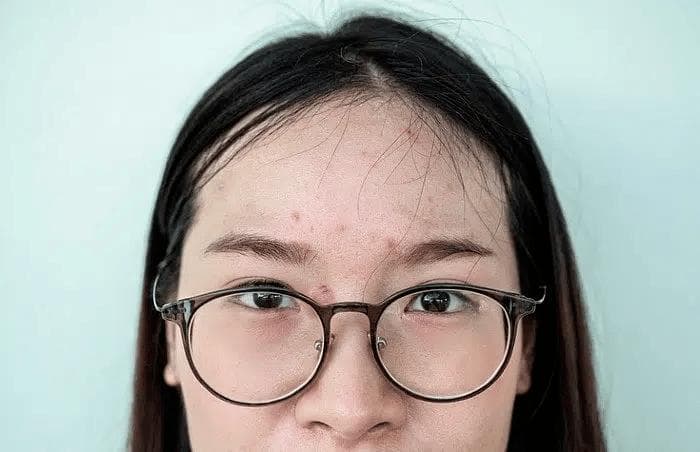 脸长痘痘怎么办：新加坡10大最常见的暗疮错误观念