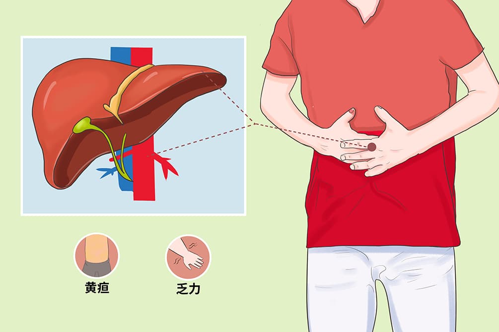 吉尔伯特综合征