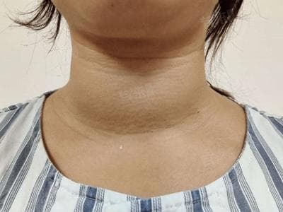 脖子粗大一定是甲状腺有问题吗？