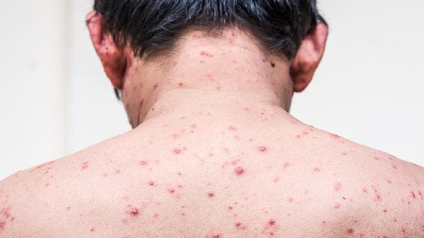 炉甘石洗剂涂抹多久？