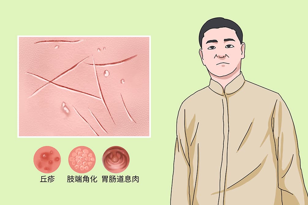 Cowden综合征：罕见遗传病的全面解析