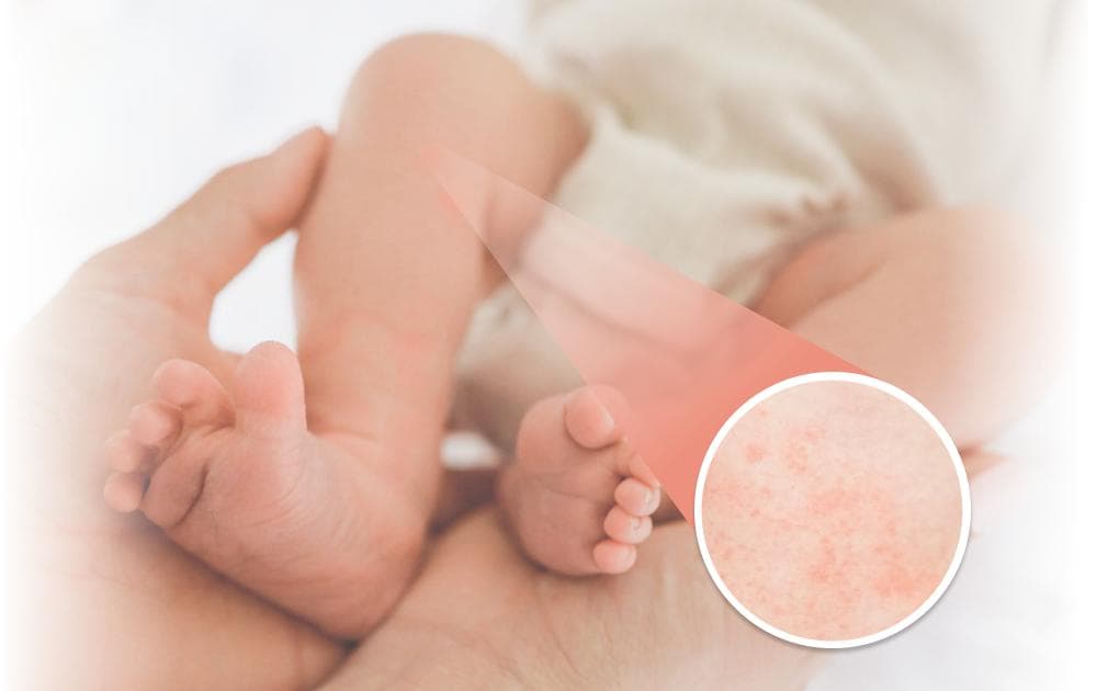 婴儿热疹怎么办？出现原因、7种远离热疹方法与常见问题一次看！