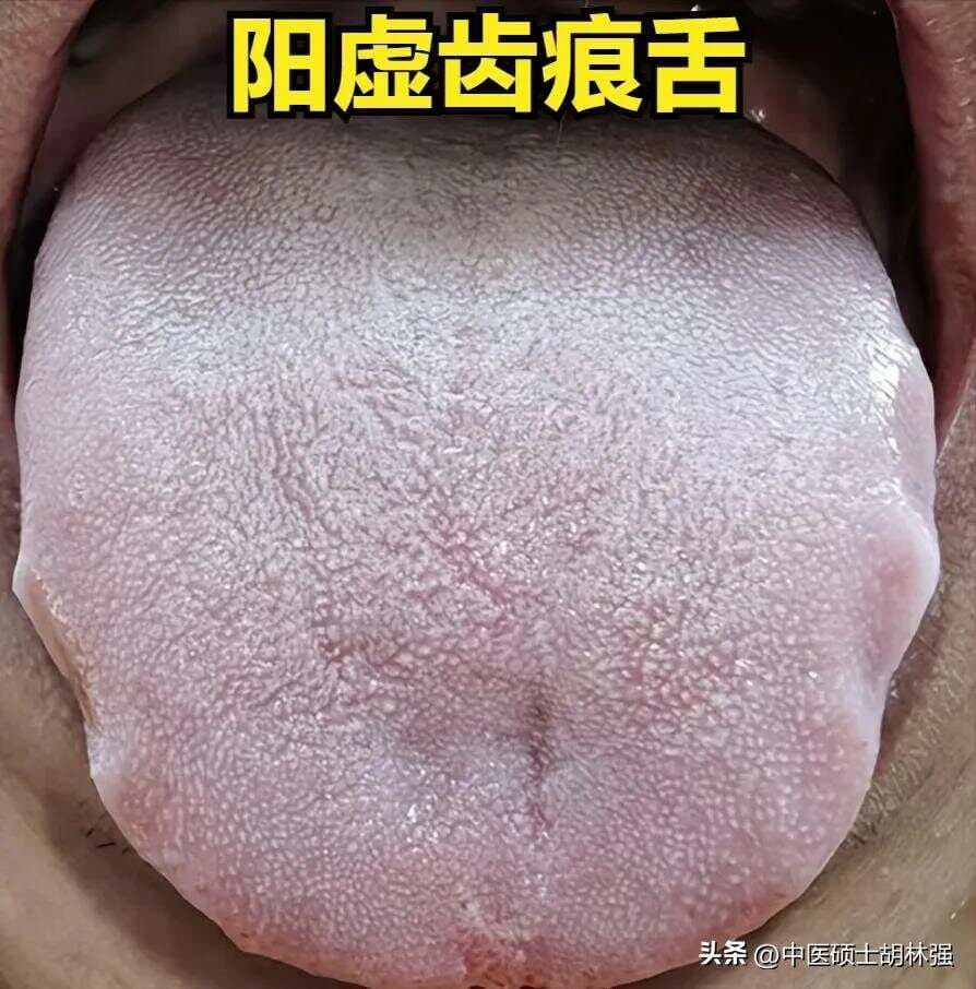 脾虚齿痕舌、肝郁齿痕舌、阳虚也会齿痕舌，中医教你正确调！