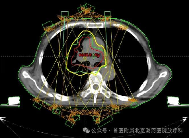 不同类型的放射治疗：为不同肿瘤量身定制的治疗方案