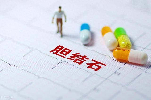 胆结石患者到底能不能吃鸡蛋