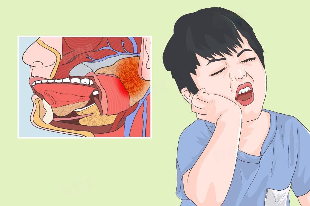 腮腺炎的治疗方法