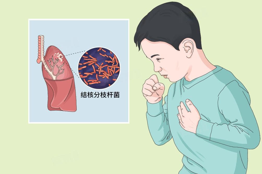 肺结核能自愈吗