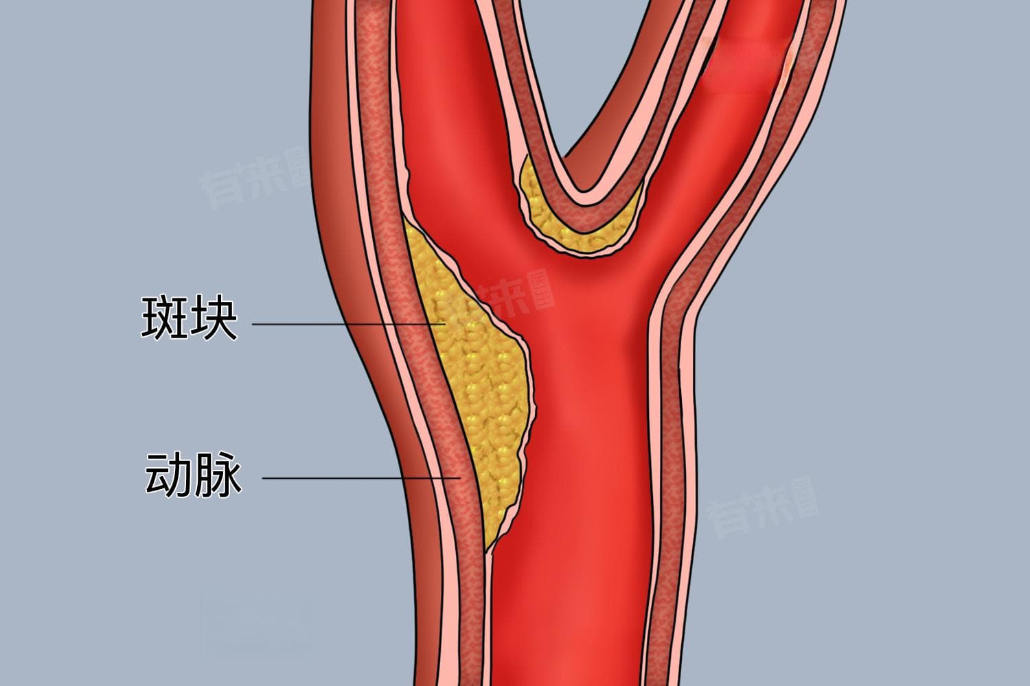 右侧锁骨下动脉斑块：原因、治疗与预后