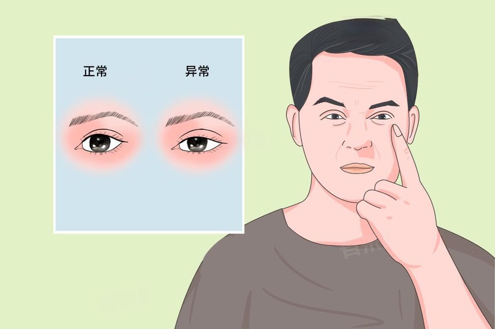 眼睑下垂可能是什么病？一文详解病因、检查与预后