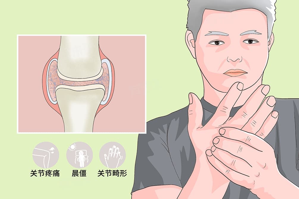 类风湿是什么症状