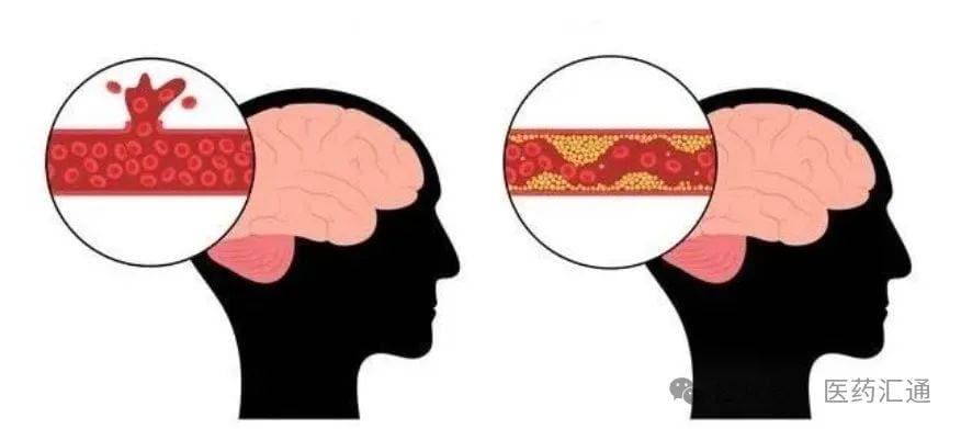 八成中风可以预防