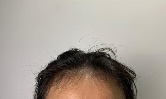 女人为什么脱发严重？如何有效预防和治疗？