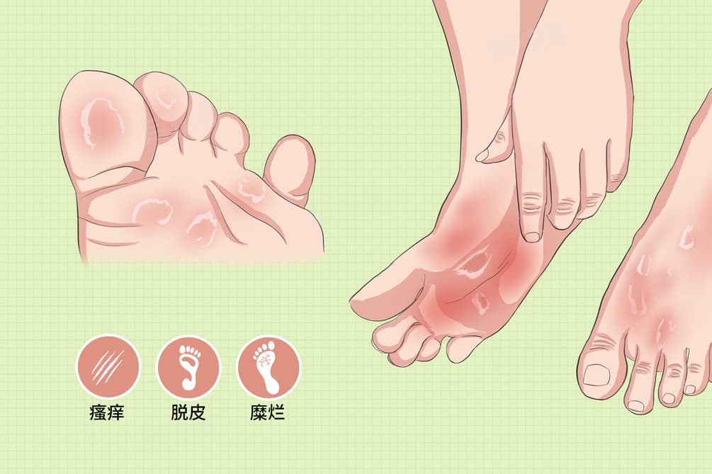 足癣的特征是什么