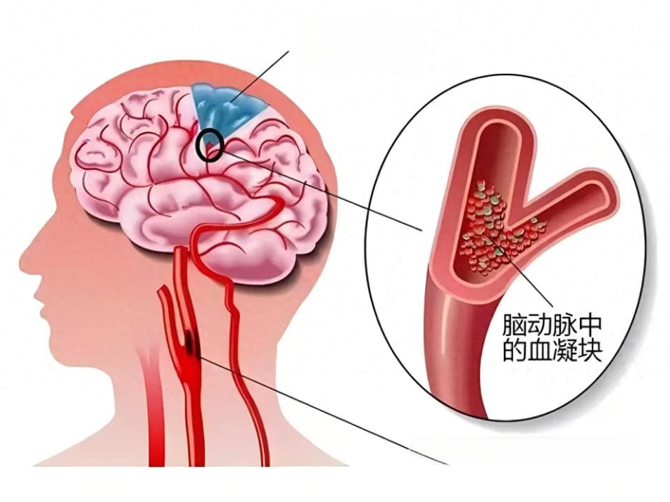 发现颈部血管斑块，都要吃他汀类药物吗？提醒您别过度治疗
